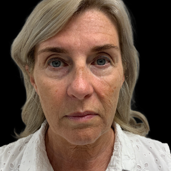 deepplane-facelift-before